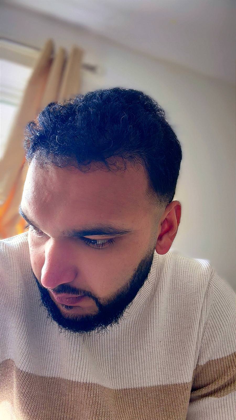 Norwood 7 hair transplant — Hussain result photo 6